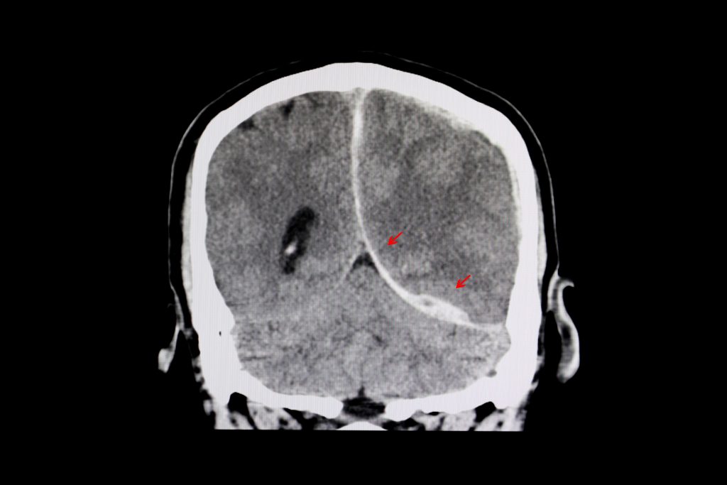 Traumatic Brain Injuries... Detection And Impact